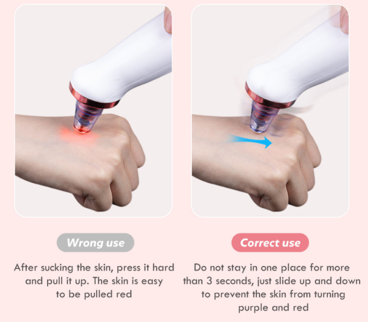 remedy for blackheads